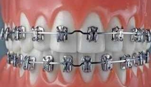 牙齿矫正
