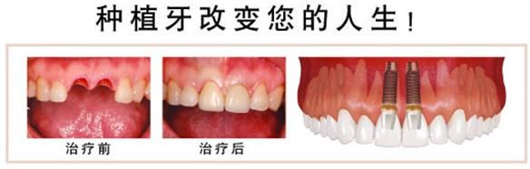 种植牙改变你的人生