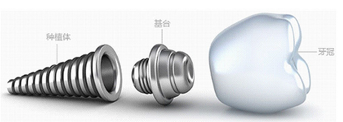 种植牙组成结构
