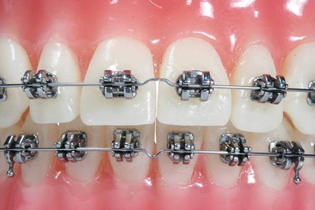 康贝佳牙齿矫正
