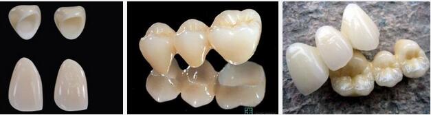 无锡做一颗烤瓷牙多少钱