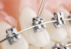 在无锡想做牙齿矫正选择哪里比较合适?