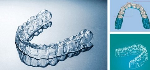 无锡成人做隐形矫正哪家口腔好